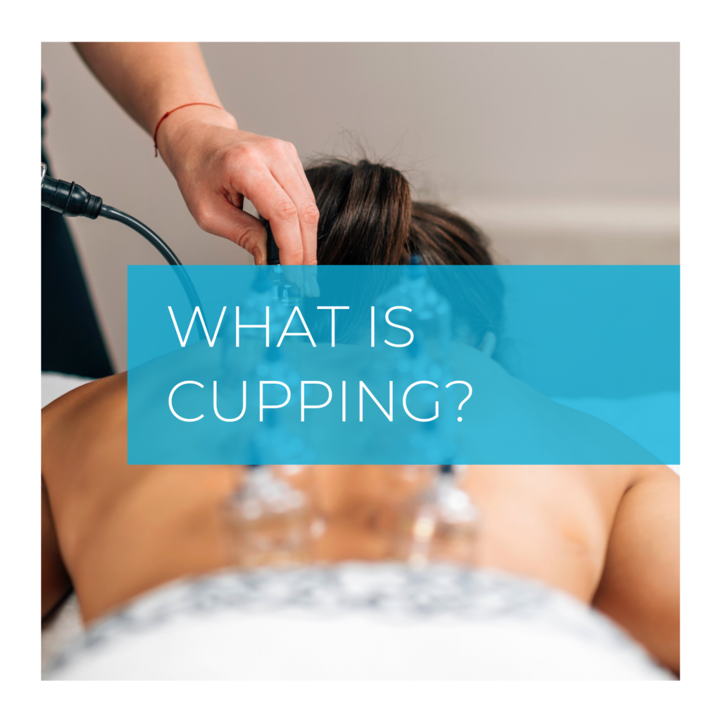 What is cupping